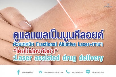 ดูแลแผลเป็นนูนคีลอยด์ ด้วยเทคนิค Fractional Ablative Laser+ทายา*โดยไม่ต้องฉีดยา* :Laser assisted drug delivery