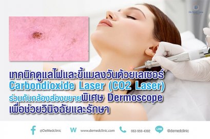 เทคนิคดูแลไฝและขี้แมลงวันด้วยเลเซอร์ Carbondioxide Laser (CO2 Laser) ร่วมกับกล้องส่องขยายพิเศษ Dermoscope เพื่อช่วยวินิจฉัยและรักษา