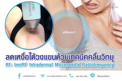 ลดเหงื่อใต้วงแขนด้วยเทคนิคคลื่นวิทยุ RF: InfiniRF Intradermal Microneedle Radiofrequency