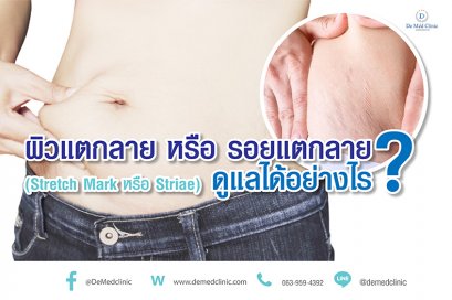 ผิวแตกลาย หรือ รอยแตกลาย (Stretch Mark หรือ Striae) ดูแลได้อย่างไร ?