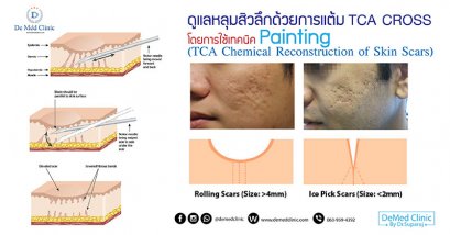 ดูแลหลุมสิวลึกด้วยการแต้ม TCA CROSS โดยการใช้เทคนิค Painting (TCA Chemical Reconstruction of Skin Scars)