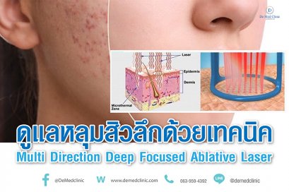ดูแลหลุมสิวลึกด้วยเทคนิค Multi Direction Deep Focused Ablative Laser