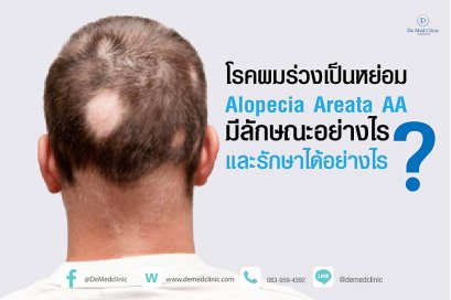 โรคผมร่วงเป็นหย่อม Alopecia Areata AA มีลักษณะอย่างไรและรักษาได้อย่างไร ?