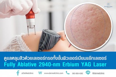 ดูแลหลุมสิวด้วยเลเซอร์กรอทั้งชั้นผิวเออร์เบียมแย๊กเลเซอร์ Fully Ablative 2940-nm Erbium YAG Laser