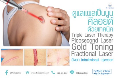 ดูแลแผลเป็นนูน คีลอยด์ ด้วยเทคนิค Triple Laser Therapy: Picosecond Laser + Gold Toning + Fractional Laser + ฉีดยา Intralesional Injection