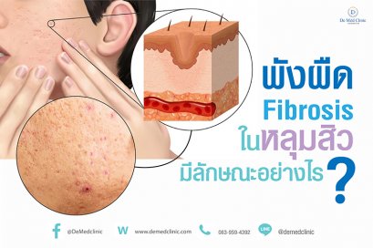 พังผืด Fibrosis ในหลุมสิวมีลักษณะอย่างไร ?
