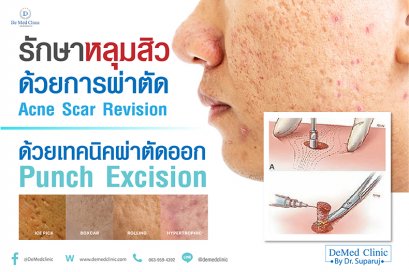 รักษาหลุมสิวด้วยการผ่าตัด Acne Scar Revision ด้วยเทคนิคผ่าตัดออก Punch Excision