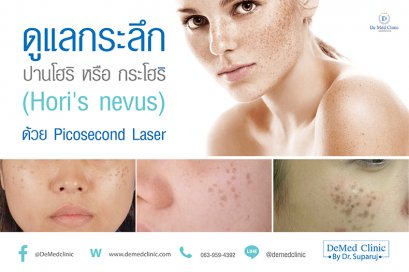 ดูแลกระลึก หรือปานโฮริ หรือ กระโฮริ (Hori's nevus) ด้วย Picosecond Laser