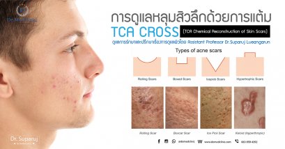 การดูแลหลุมสิวลึกด้วยการแต้ม TCA CROSS (TCA Chemical Reconstruction of Skin Scars)