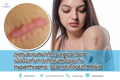 ดูแลรอยแผลผ่าตัด Surgical Scar เพื่อป้องกันการเกิดแผลเป็นนูนเกิน Hyperthrophic Scar และคีลอยด์ Keloid