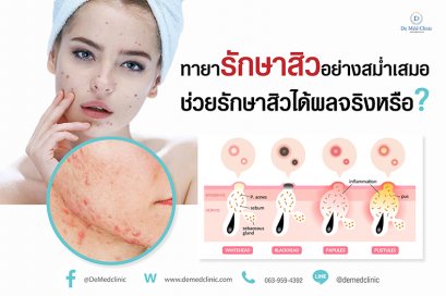 ทายารักษาสิวอย่างสม่ำเสมอช่วยรักษาสิวได้ผลจริงหรือ ?