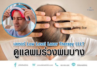 เลเซอร์ Low Level Laser Therapy LLLT ดูแลผมร่วงผมบาง