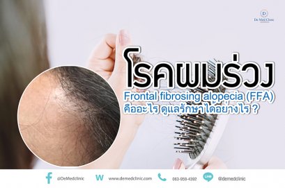 โรคผมร่วง Frontal fibrosing alopecia (FFA) คืออะไร ดูแลรักษาได้อย่างไร ?