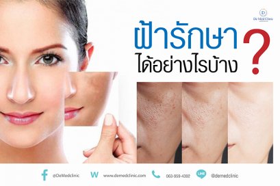 ฝ้ารักษาได้อย่างไรบ้าง