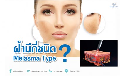 ฝ้ามีกี่ชนิด Melasma Type?