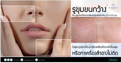 รูขุมขนกว้าง คือรูขุมขนที่มีขนาดเส้นผ่าศูนย์กลางเกิน 0.3-0.5 มม. ในผู้หญิงมักมีปัญหาเรื่องเครื่องสำอางติดในหลุมหรือทาเครื่องสำอางไม่ติด 