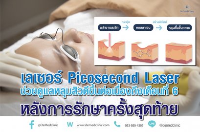 เลเซอร์ Picosecond Laser ช่วยดูแลหลุมสิวดีขึ้นต่อเนื่องถึงเดือนที่ 6 หลังการรักษาครั้งสุดท้าย  