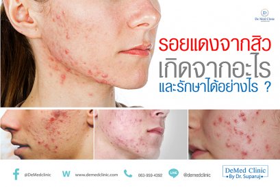 รอยแดงจากสิวเกิดจากอะไรและรักษาได้อย่างไร ?