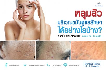 หลุมสิวบริเวณขมับดูแลรักษาได้อย่างไรบ้าง?