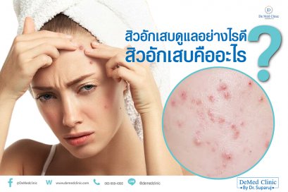 สิวอักเสบดูแลอย่างไรดี และ สิวอักเสบคืออะไร?