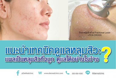 แนะนำเทคนิคดูแลหลุมสิว : แผลเป็นหลุมสิวที่จมูก ดูแลได้อย่างไรบ้าง ?