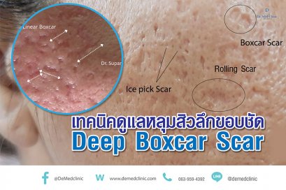 เทคนิคดูแลหลุมสิวลึกขอบชัด Deep Boxcar Scar !!