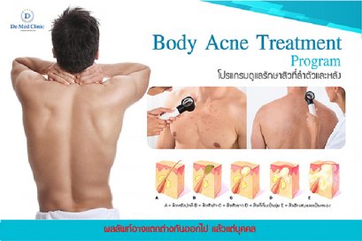 Body Acne Treatment Program โปรแกรมดูแลรักษาสิวที่ลำตัวและหลัง