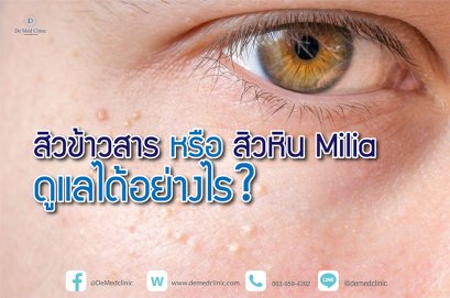 สิวข้าวสาร หรือสิวหิน Milia ดูแลได้อย่างไร ?