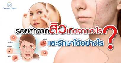 รอยดำจากสิว เกิดจากอะไร และ รักษาได้อย่างไร ?