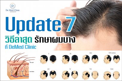 Update 7 วิธีล่าสุด รักษาผมบาง ที่ DeMed Clinic
