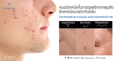 หมอมีเทคนิคในการดูแลรักษาหลุมสิวอีกเทคนิคมาฝากกันครับ