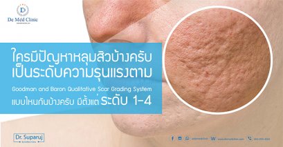 ใครมีปัญหาหลุมสิวบ้างครับ เป็นระดับความรุนแรง ตาม Goodman and Baron Qualitative Scar Grading System ไหนกันบ้างครับ มีตั้งแต่ ระดับ 1-4