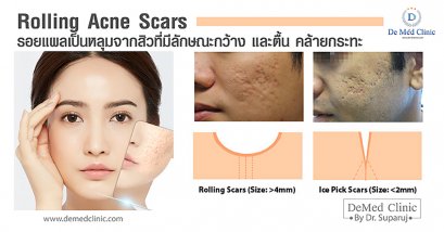 Rolling Acne Scars รอยแผลเป็นหลุมจากสิวที่มีลักษณะกว้าง และตื้น คล้ายกระทะ ก้นแผลจะดูไม่เรียบ เกิดจากสิวอักเสบขนาดใหญ่ที่เกิดการยุบตัวลงของผิว รอยยุบเป็นแอ่งกว้างคล้ายกระทะ