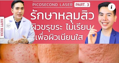 ขอขอบคุณ คุณนุชา Happy Nucha สำหรับการรีวิวการรักษาหลุมสิวกับหมอรุจครับ 