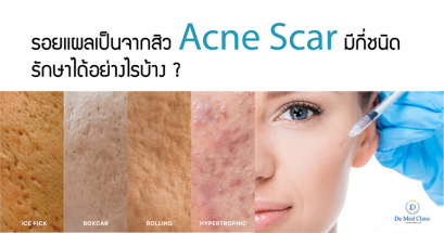 รอยแผลเป็นจากสิว Acne Scar มีกี่ชนิด รักษาได้อย่างไรบ้าง ?