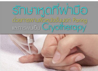รักษาหูดที่ฝ่ามือด้วยการฝานผิวหนังชั้นนอก Paring และการพ่นเย็น Cryotherapy 