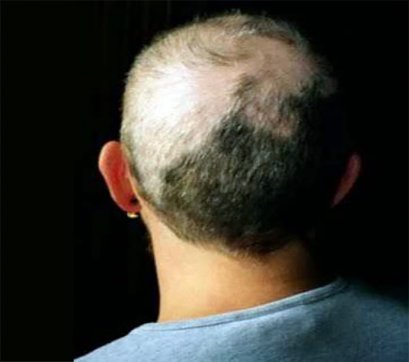 ผมร่วงจากโรคดึงผมตัวเอง (#Trichotillomania) 