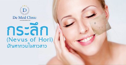 กระลึก (Nevus of Hori) ปัญหากวนใจสาวสาว