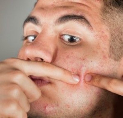 หนุ่มหนุ่มหลายท่านมาปรึกษาหมอ ด้วยปัญหาเป็น สิวบริเวณแก้ม คาง เคราบริเวณที่เป็นหนวดโดยจะเป็นมากหลังโกนหนวด