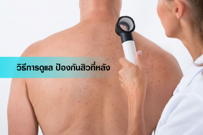 สิวที่หลัง (back acne หรือ #bacne) เป็นปัญหากวนใจสำหรับหลายๆท่านครับ ทั้งคัน เจ็บ เป็นรอยไม่สวย
