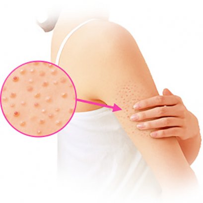การรักษา ขนคุด Keratosis pilaris