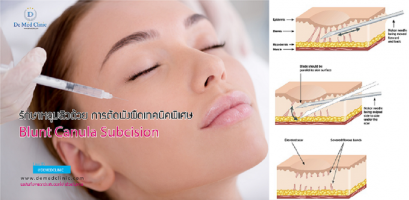 รักษาหลุมสิวด้วย การตัดพังผืดเทคนิคพิเศษ Blunt Canula Subcision 