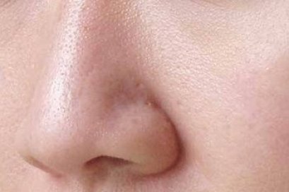 Laser Rejuvenation Program ลดริ้วรอย ยกกระชับ หน้าใส รูขุมขนดูเล็กลง