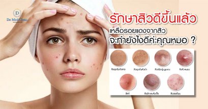 รักษาสิวดีขึ้นแล้ว เหลือรอยแดงจากสิวจะทำยังไงดีค่ะคุณหมอ ? 