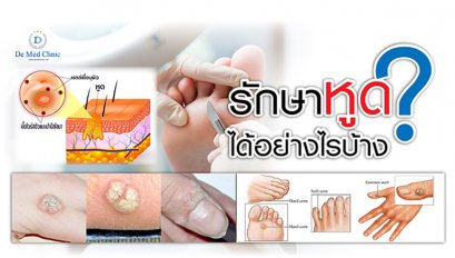 รักษาหูดได้อย่างไรบ้าง ?