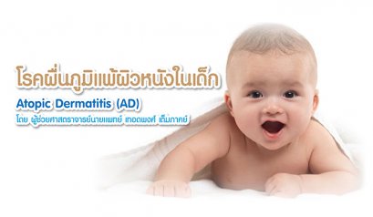 โรคผื่นภูมิแพ้ผิวหนังในเด็ก Atopic Dermatitis (AD) โดย ผู้ช่วยศาสตราจารย์นายแพทย์ เทอดพงศ์ เต็มภาคย์ 