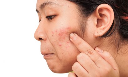 ผิวเป็นสิวและแพ้ง่ายผิวเป็นสิวหรือแท้จริงแล้วผิวแพ้ง่าย?