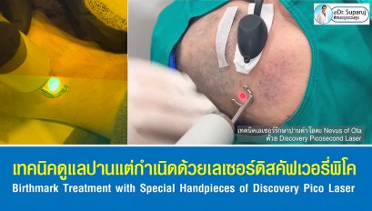 เทคนิคดูแลปานแต่กำเนิดด้วยเลเซอร์ดิสคัฟเวอรี่พิโค Birthmark Treatment with Special Handpieces of Discovery Pico Laser