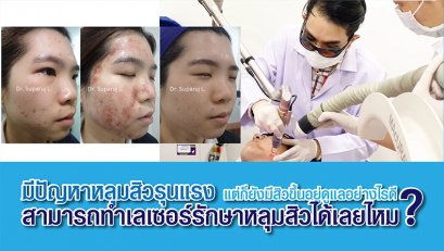 มีปัญหาหลุมสิวรุนแรง แต่ก็ยังมีสิวขึ้นอยู่ดูแลอย่างไรดี สามารถทำเลเซอร์รักษาหลุมสิวได้เลยไหม?