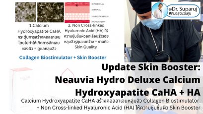 Update Skin Booster ตัวใหม่ Neauvia Hydro Deluxe: Calcium Hydroxyapatite CaHA สร้างคอลลาเจนหลุมสิว Collagen Biostimulator + Non Cross-linked Hyaluronic Acid (HA) ให้ความชุ่มชื้นผิว Skin Booster ครับ